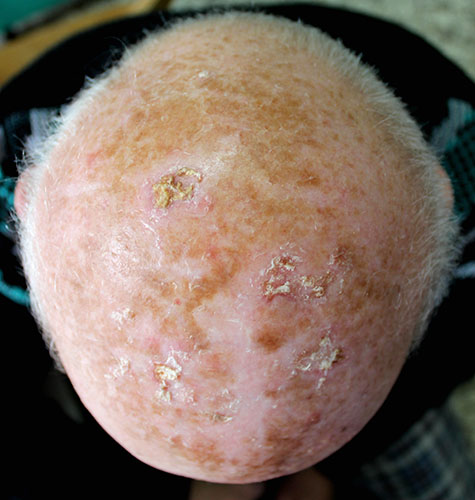 Actinic keratosis (solar keratosis) on the scalp of an elderly man.