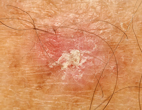 A case of actinic keratosis (solar keratosis).