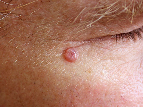 A case of nodular basal cell carcinoma