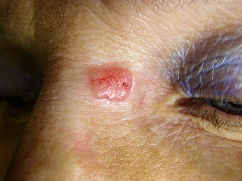 Basal cell carcinoma on the skin of the face. Skin Cancer.