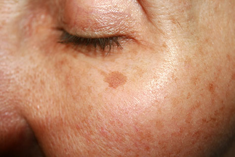 Brown Spots and Freckles  Faciem Dermatology Clinic