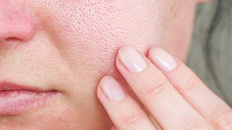 Macro skin with enlarged pores. The girl touches the irritated red skin with her fingers.