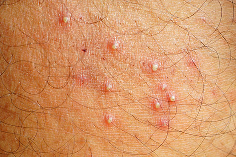 Folliculitis Inflammatory glands or inflammatory follicles