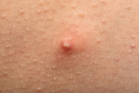 Close up picture of pimple with pus on human skin, hormonal disorder