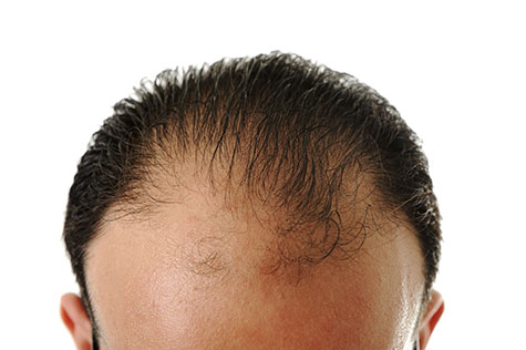 Man losing hair, baldness