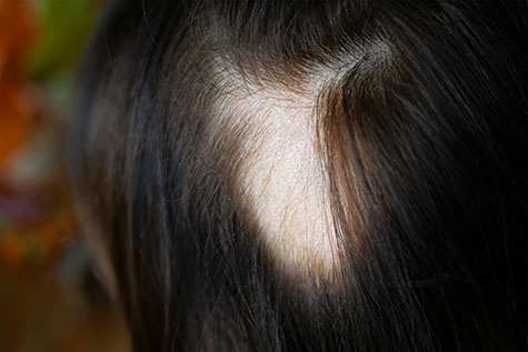 Woman hair loss. Head of woman on part of skin of which there is no hair. Maybe this is alopecia areata, lichen, trichopetia, microsporia. Close-up
