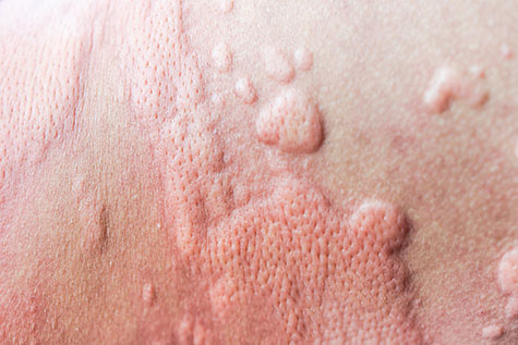urticaria on skin. rashes, of which urticaria and toxic erythema are the most common.