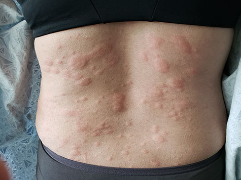 Urticaria or hives on the human back