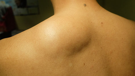 Lipoma of the shoulder back.