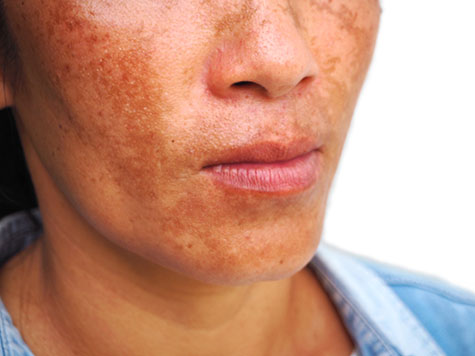 Close up melasma on woman face, skin problem