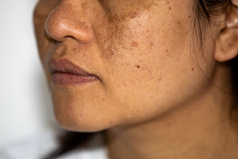 Young Asian women having a skin problem with melasma and hyperpigmentation on her face. both side on her cheeks.