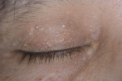 close up of the eyelid inclusion cyst during eye examination.