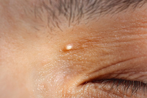 Milia on the skin of the face (also called a milium, plural milia, milk spot or an oil seed). Macro shot.