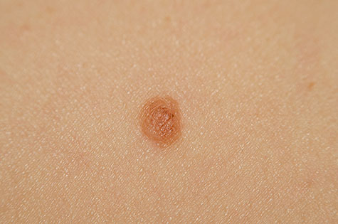 Nevus on the skin of a woman close-up