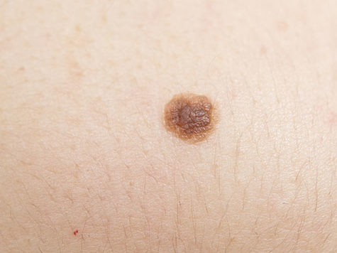 close up of mole on human skin