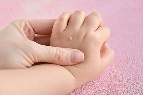 The doctor holds a small hand of a child affected with warts with selective focus on blurred pink background. Papillomavirus in a child's hand and fingers. Pediatric dermatology. Skin diseases