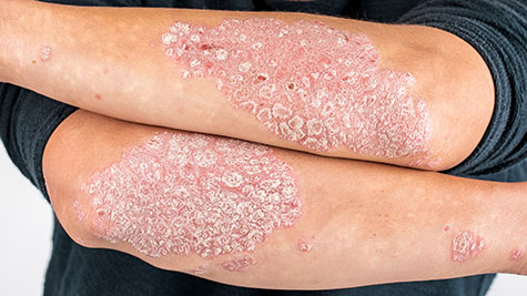 psoriasis vulgar