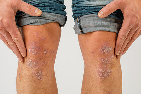 Close-up of the legs of a man suffering from chronic psoriasis on a white background