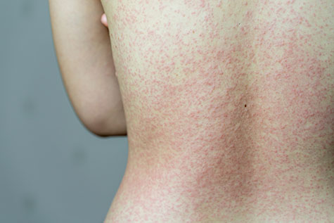 Close up Allergy rash, Around Back view of asian women with dermatitis problem of rash ,Allergy rash and Health problem.