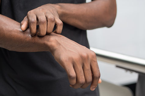 man suffering from itching skin; sick african man scratching his skin with allergy, rash, ringworm, tinea problem; health care, skin care, dermatology concept; adult african man, black man model