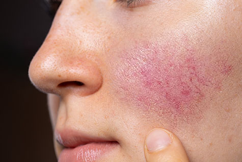 A young Caucasian lady is seen closeup, pointing towards her rosy red cheeks. A common symptom of rosacea in young adults. Copy space on the right.