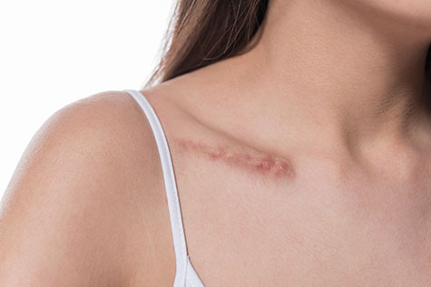 woman showing surgery scar. Scars removal concept, close up, selective focus