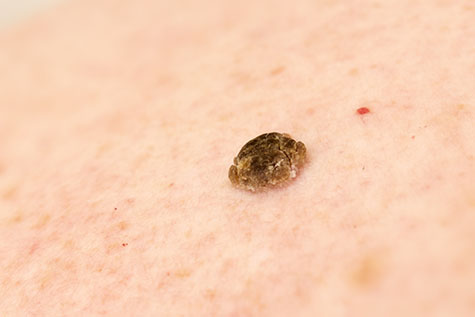 Seborrheic keratosis also known as seborrheic verruca or a senile wart, narrow focus