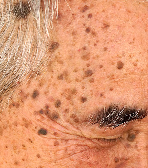 Old Asian man's head full of freckles and Seborrheic keratosis, seborrheic verruca, senile wart, benign skin tumor