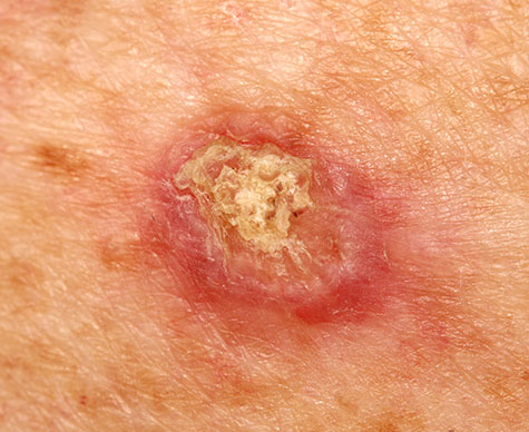 A case of an invasive squamous cell carcinoma.