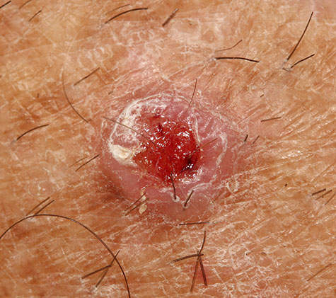 A case of an invasive squamous cell carcinoma.