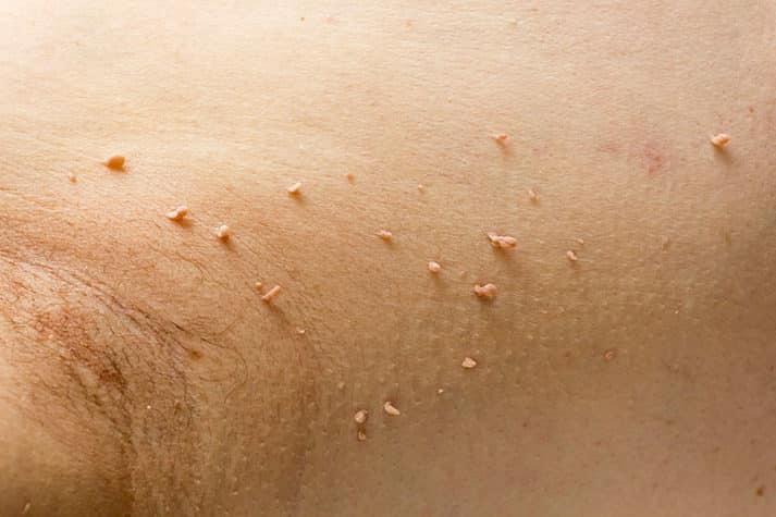 Papilloma virus in the human armpit, the concept of skin disease