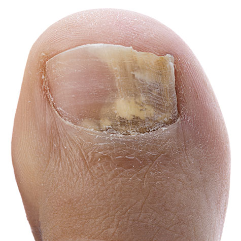 Toenail Fungus Isolated