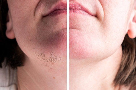 Woman with hairs on chin. Hair removal on face.