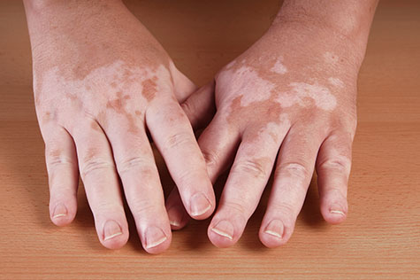 Vitiligo is a medical condition causing depigmentation of patches of skin