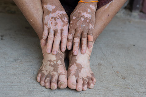 The hands and feet of people with vitiligo