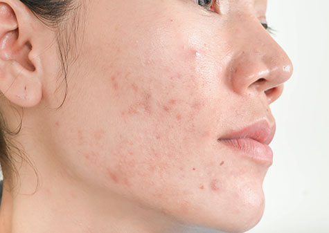 Scar from Acne on face and dark spots and skin problems and make-up in women