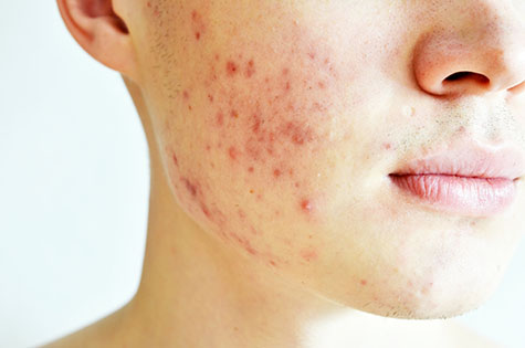 Close up of man with problematic skin and scars from acne