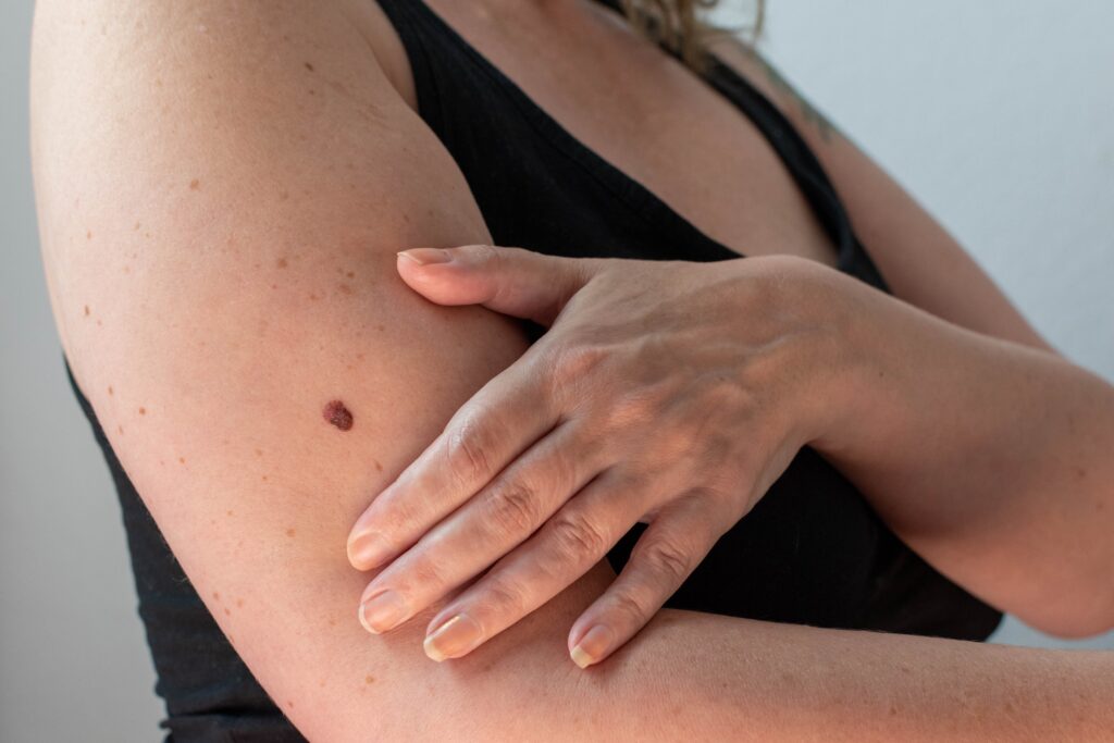 skin cancer detection dermatology
