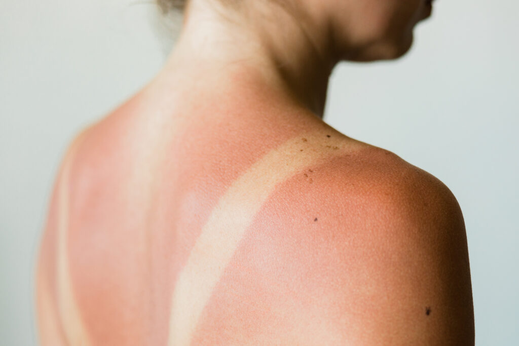 sunburn and heat rash dermatology