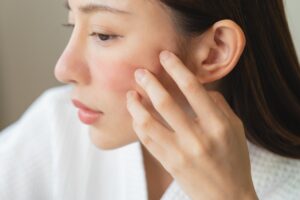 eczema treatment