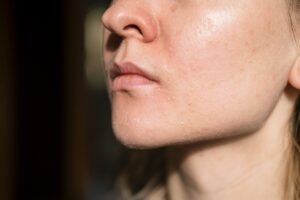 dry skin skincare