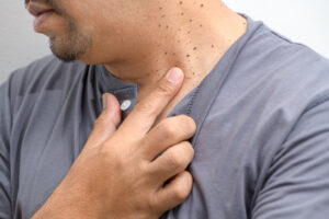 skin tag removal